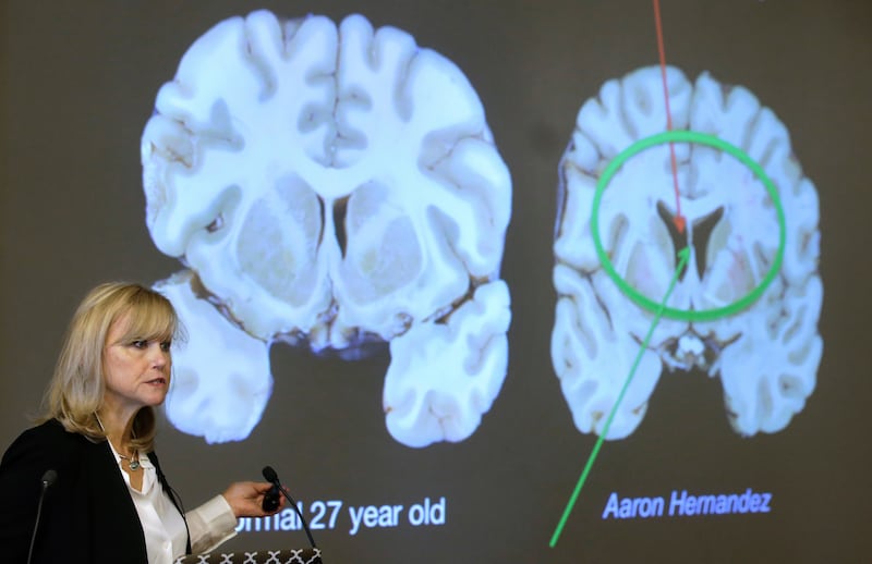 Study finds CTE in at least 25 percent of former NFL players who died 2016-2021